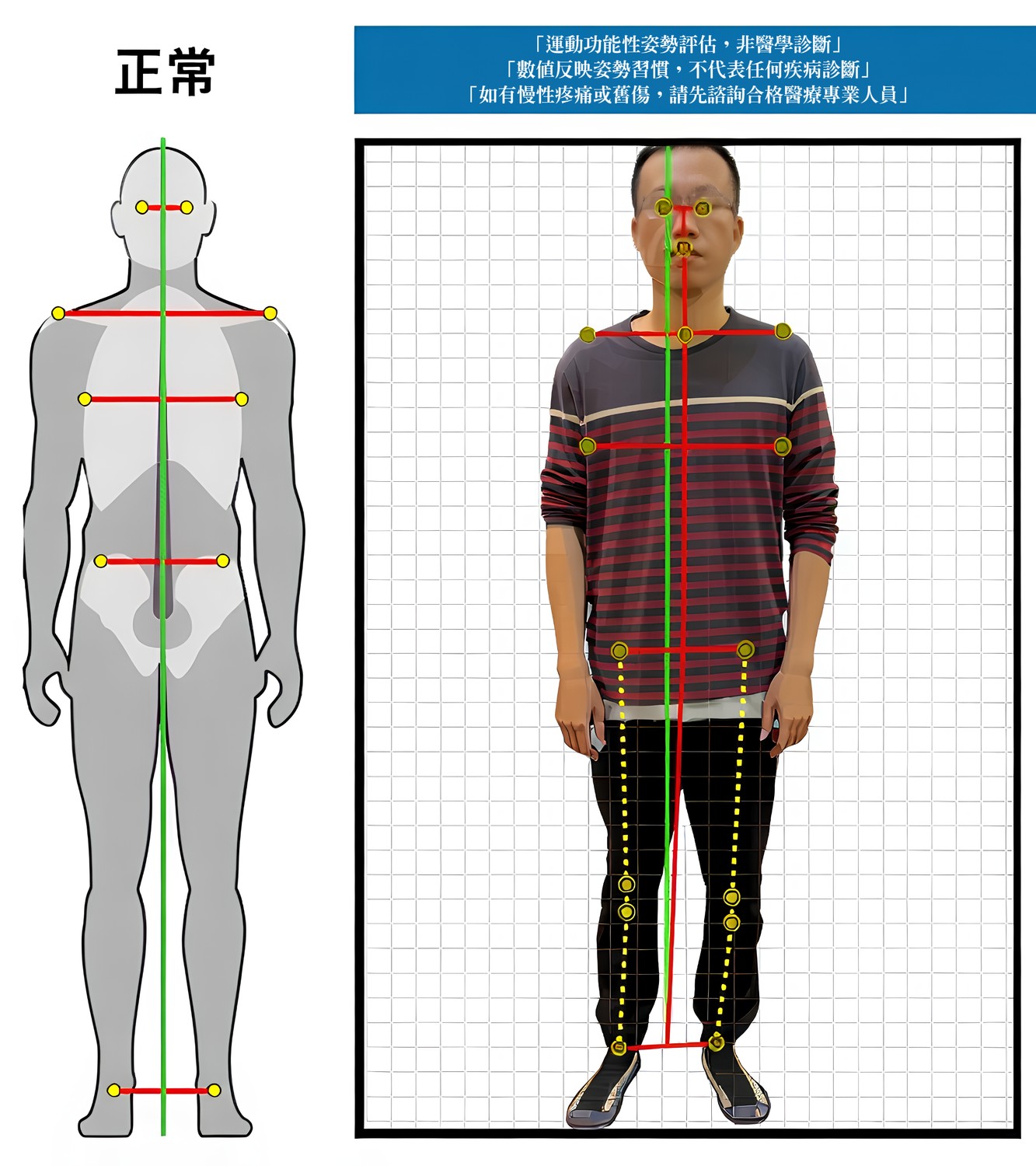 AI 體態檢測範例報告：正面姿勢分析與角度數值